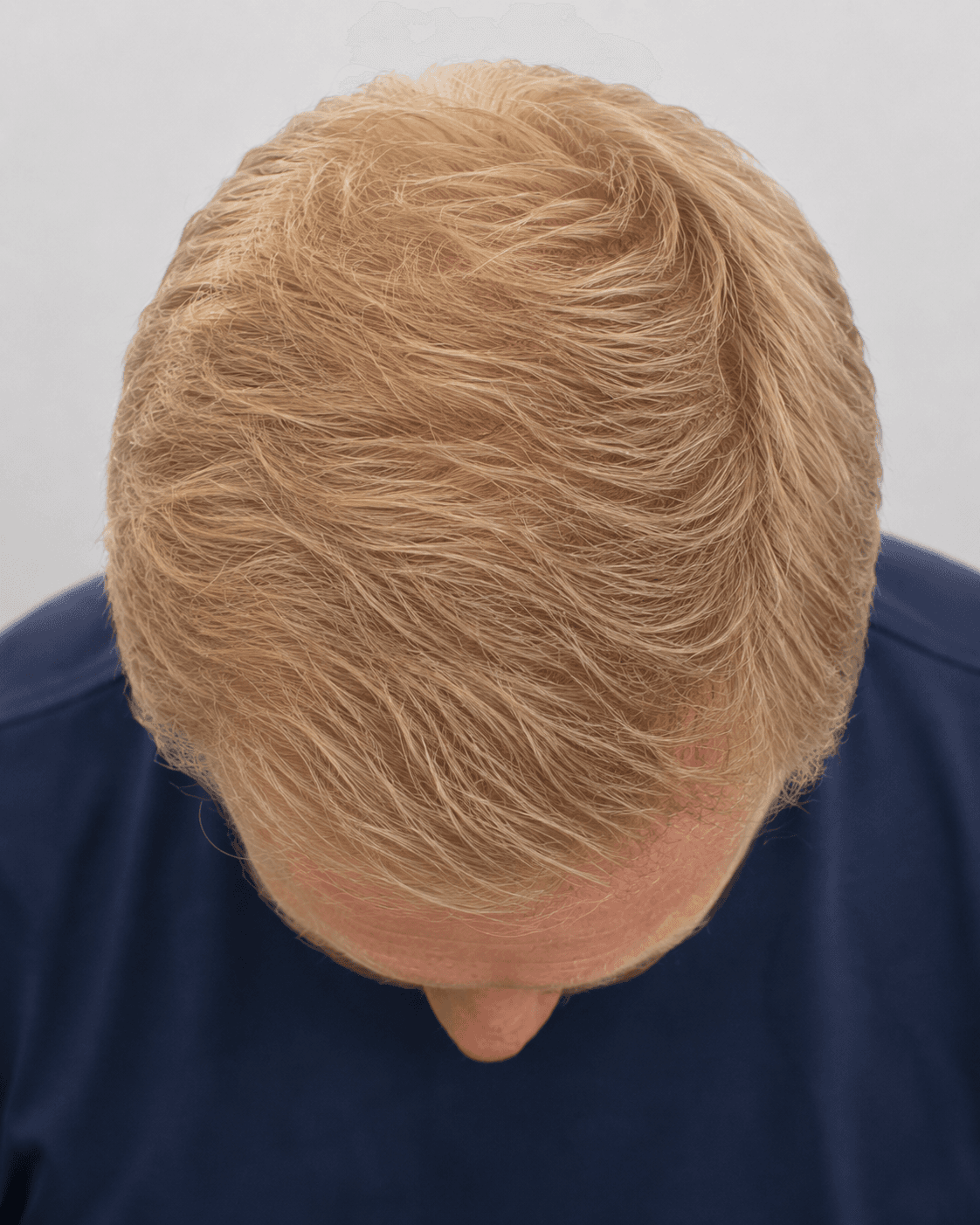 Hjässa efter hårtransplantation