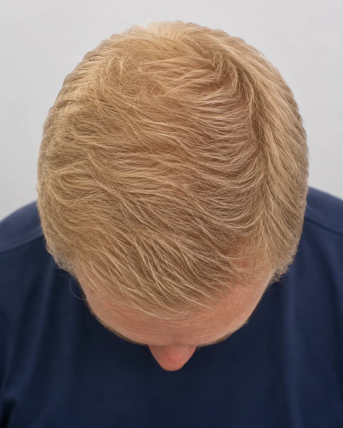 Hjässa efter hårtransplantation