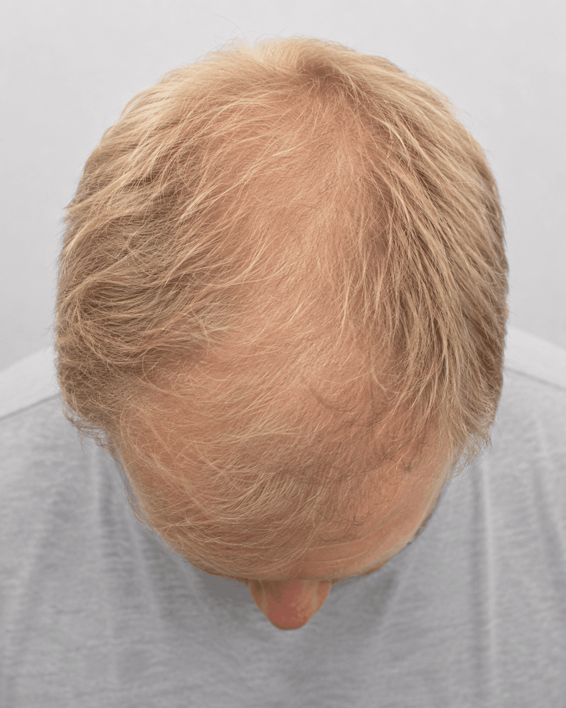 Hjässa före hårtransplantation