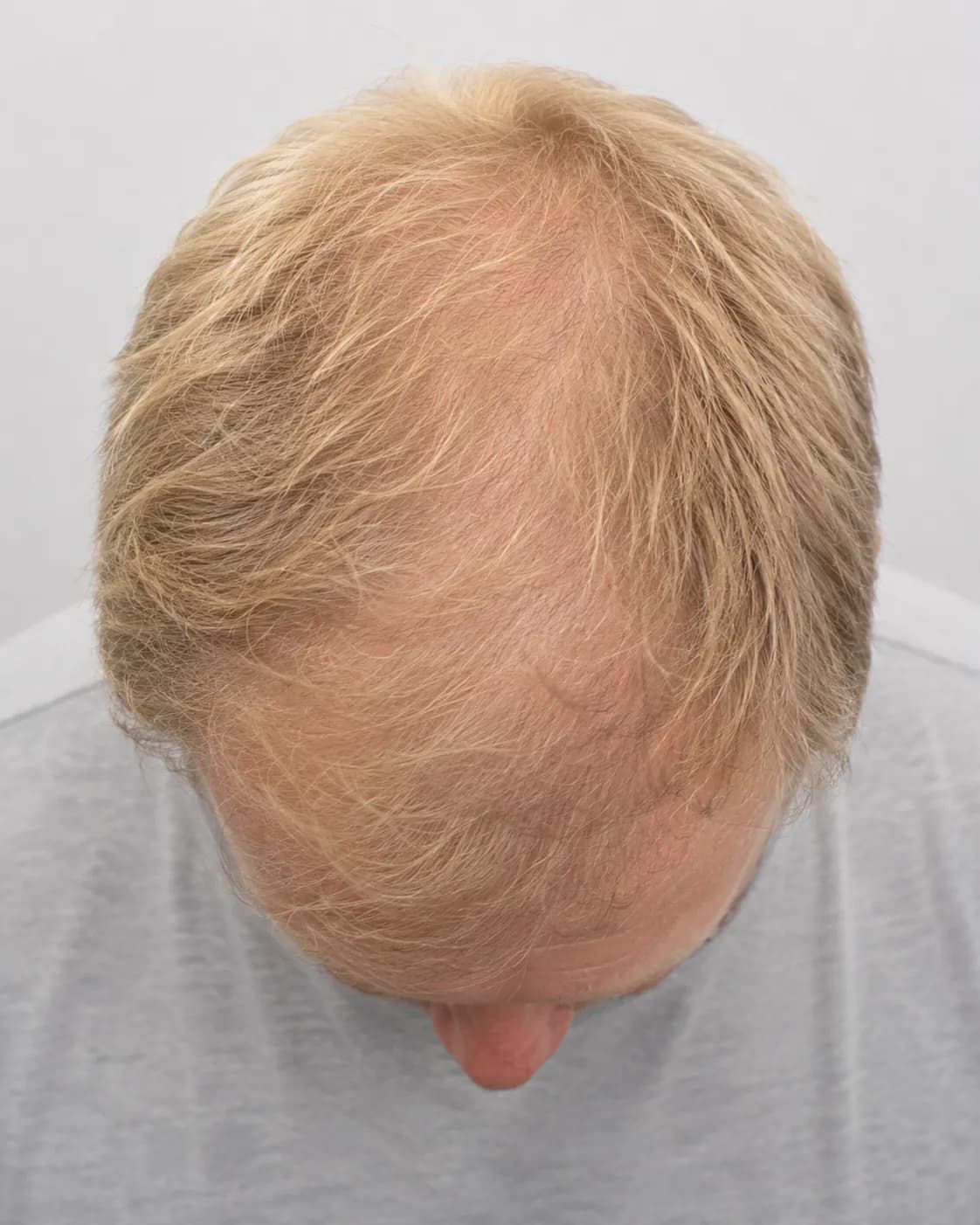 Hjässa före hårtransplantation